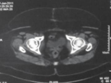 On investigation, her chest X-ray and CT scans revealed right pleural effusion, mediastinal lymphadenopathy, and abdominal lymphadenopathy.