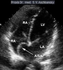 Echocardiography - which type for what?