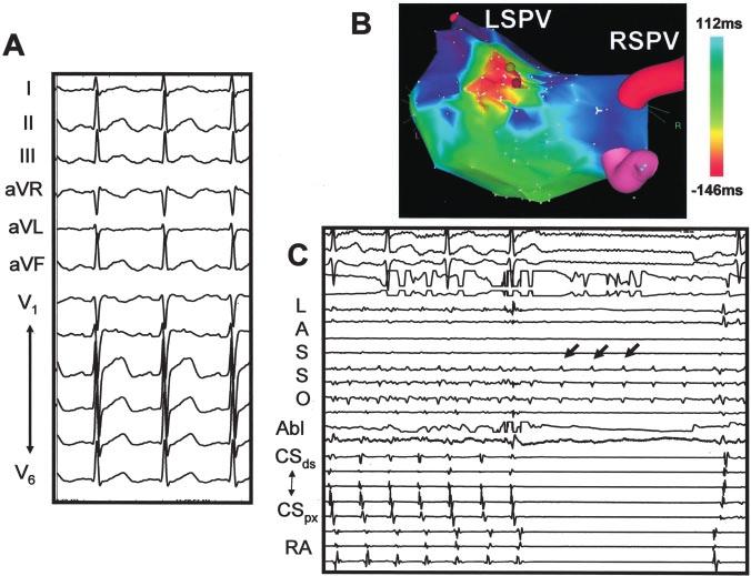 Gerstenfeld et al Left Atrial Tachycardias After PVI 1353 Figure 1. Surface ECG (A), electroanatomic map (B), and intracardiac activation (C) during left atrial tachycardia in patient 7.