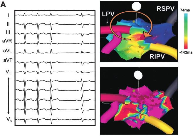 B, Electroanatomic activation map acquired during stable tachycardia revealing earliest activation (in red) at the posterior left atrium just outside the left pulmonary veins with concentric spread