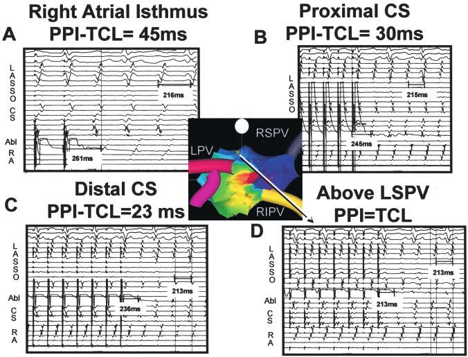 during atrial tachycardia in patient 8. Entrainment of tachycardia from 2 different bipoles of the Lasso catheter located at the RSPV ostium near the site of early activation is shown in A and B.
