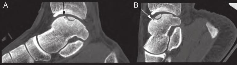 CT of plantarflexed ankle for talar OCD Figure 2. Sagittal reconstructed images of CT scans of an ankle (A) in neutral position and (B) in full plantar flexion.