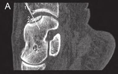 Although low-dose scans had a lower signal-to-noise ratio, this did not hamper delineation of the defects. The anterior border of the OCD is indicated by the arrows. 4 Figure 3.