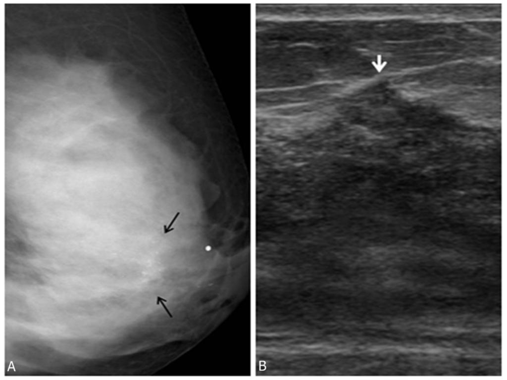 Fig. 3: IDC in a 51-year-old woman who presented with a palpable mass in left breast.