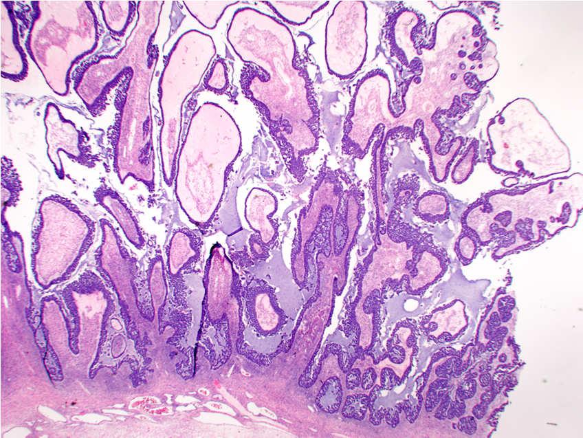 (micropapillary type)  Tumor