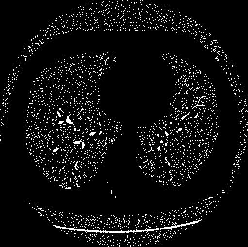 Figure 5. Some more results from the lung CT scan images. Extended maximum transformation and the identified possible region of interest are shown. 4.