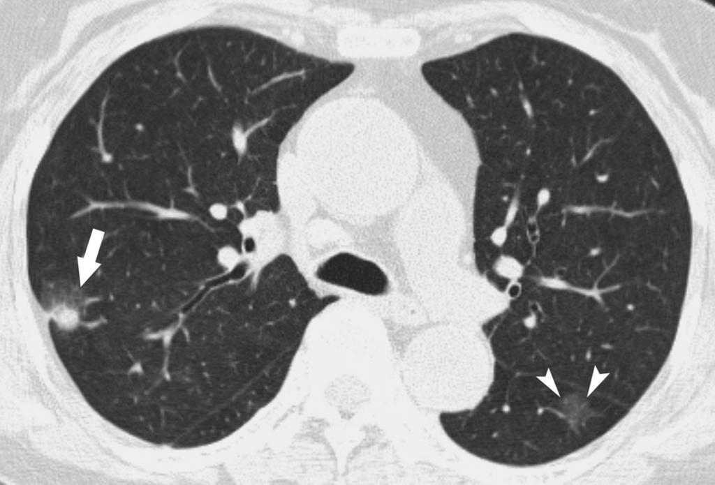 CT Findings of Pulmonary typical denomatous Hyperplasia CT Findings and the Pathologic Features of H By means of CT, we could identify and evaluate 11 pathologically proven H nodules in seven