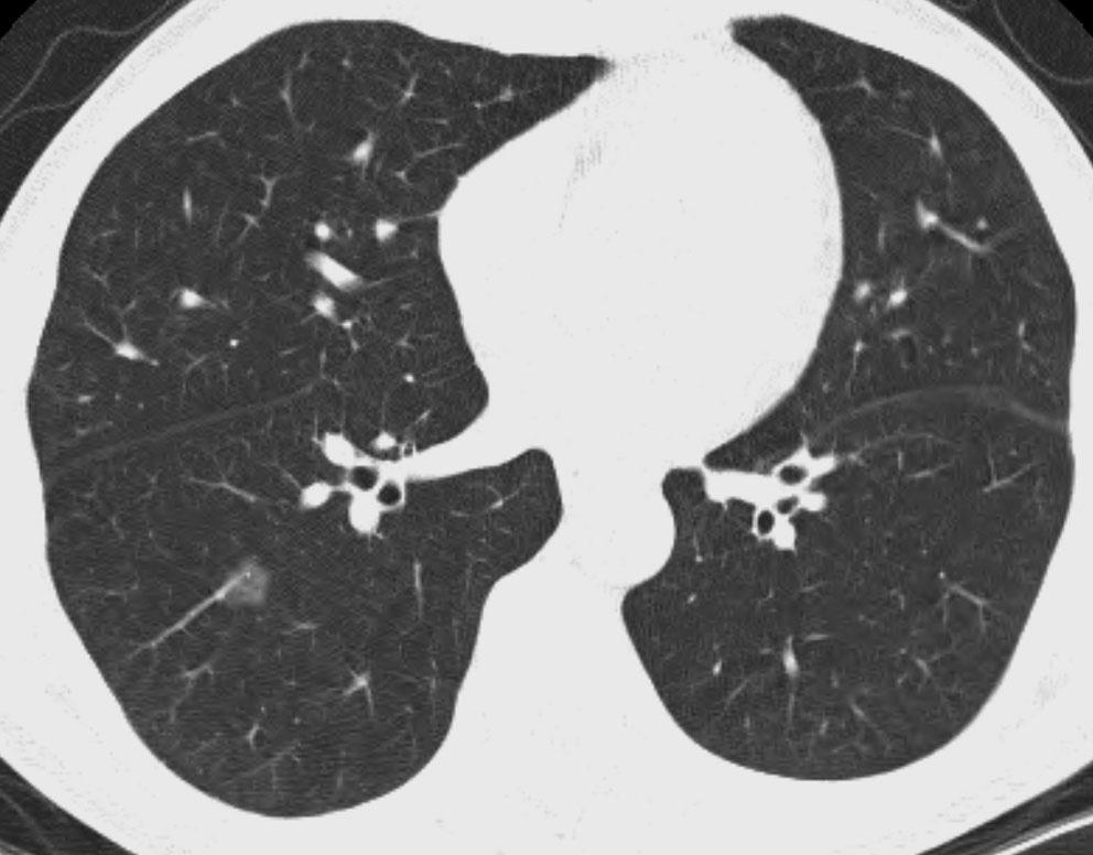 Park et al. 3.9 3 mm sized H lesion on CT, yet one 2 mm subpleural H was not identified.