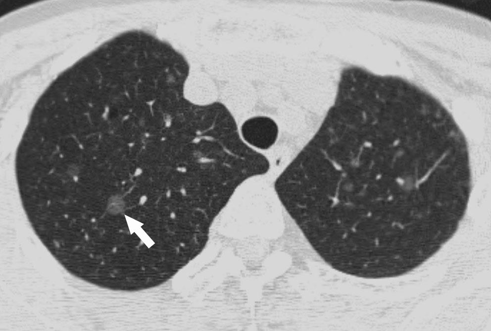 CT Findings of Pulmonary typical denomatous Hyperplasia B Fig. 3. 59-year-old woman with disseminated nodular groundglass opacitys in the bilateral lungs.