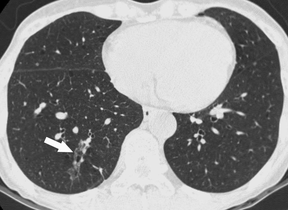 The irregular ground-glass opacity lesion (arrow) was confirmed as bronchioloalveolar carcinoma on the pathologic specimen. C throughout the whole lungs with predominance for the upper lung.