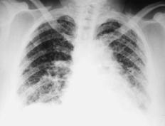 Clinical Classification Clinical History Pulmonary Fibrosis Exposure-related: - Occupational - Environmental - Avocational - Medication Desquamative interstitial pneumonia (DIP) Acute