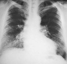 Scleroderma - Rheum. arthritis - Sjogrens - UCTD Respiratory bronchiolitis interstitial lung dis.