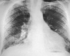 bronchiolitis ILD (RBILD) acute interstitial pneumonitis (AIP) Unclassified Drugs Occupational/Environmental -Asbestos -Birds/Molds/Organic Material (HP) Collagen Vascular Joint c/o