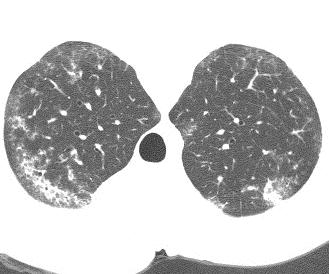 Pneumonitis (NSIP) Irregular lines in a patchy, basilar,