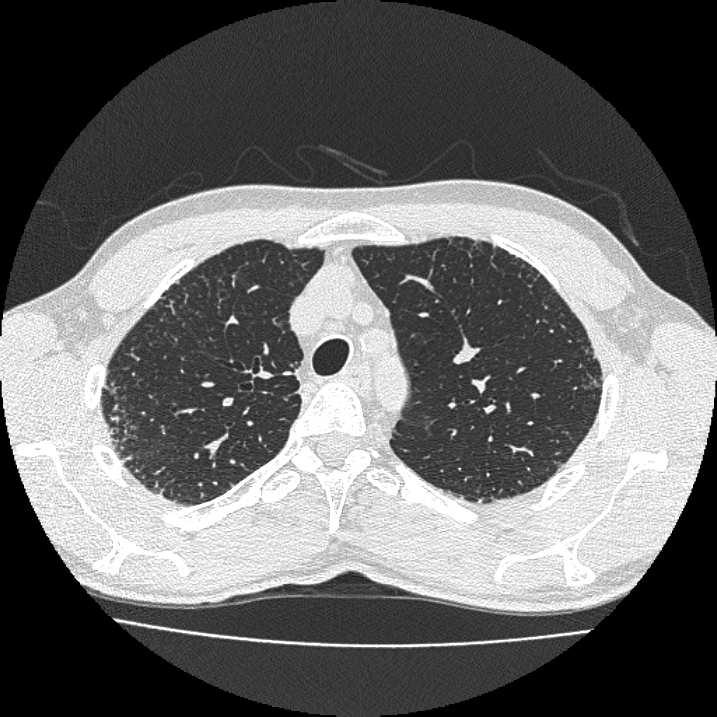 BAL and transbronchial biopsy 3. Serological evaluation 4. High resolution CT scan 5.