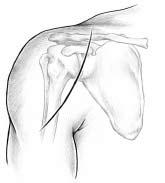 The arm and shoulder are then prepped and draped free (Figure 1).