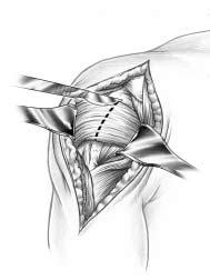 deltopectoral groove along the anterior border of the deltoid (Figure 2). The deltoid muscle is carefully retracted laterally to avoid releasing the deltoid from the clavicle.