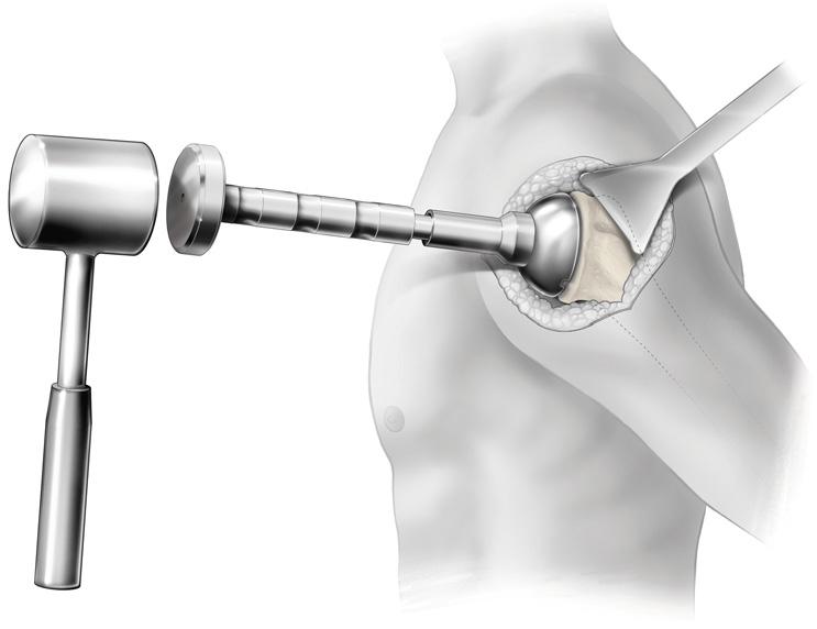 IMPLANTING THE RESURFACING HUMERAL HEAD The Head Impactor is placed onto the Impactor Handle, and is used to impact the Resurfacing Humeral Head onto the Humeral Cage.