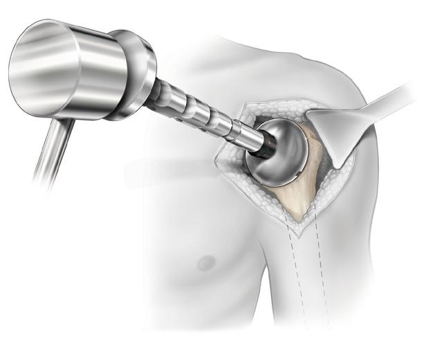 (Figure 17) Care should be taken to leave a gap of approximately 1mm between the inferior reamed surface of the humerus and the bottom rim of the Resurfacing Humeral Head to prevent stress shielding.