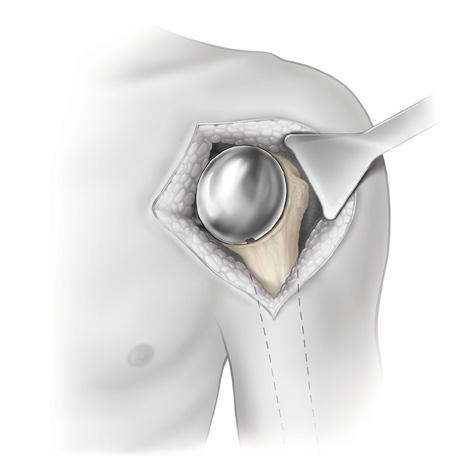 The Humeral Head Extractor is placed along the notches of the Resurfacing Humeral Head