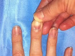 2. Nails - nail cells are produced in a region called the nail bed and, like hair, are