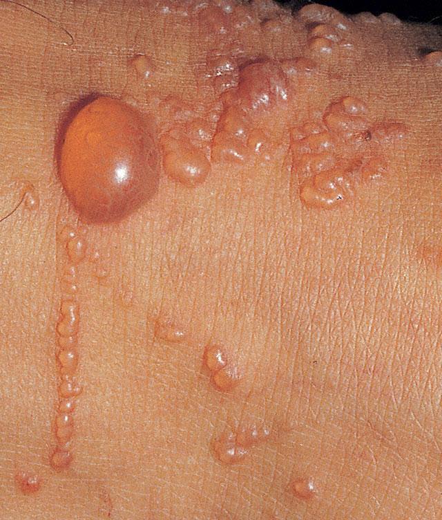 Vesicles Blisters or fluid