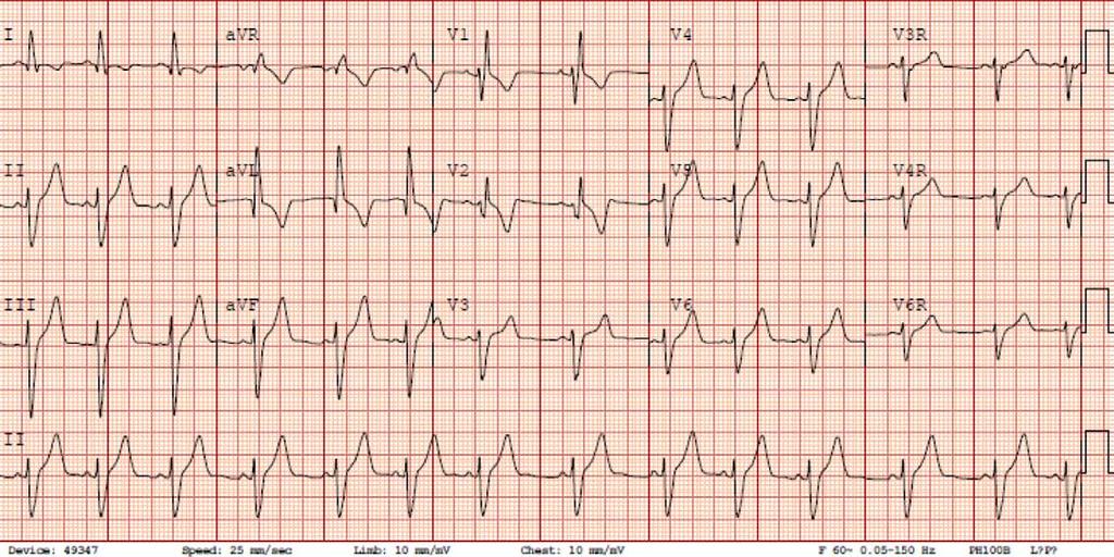 2 Moyé et al Myocardial Contusion in an 8 Year Old the subendocardial region, which is consistent with coronary ischemia.