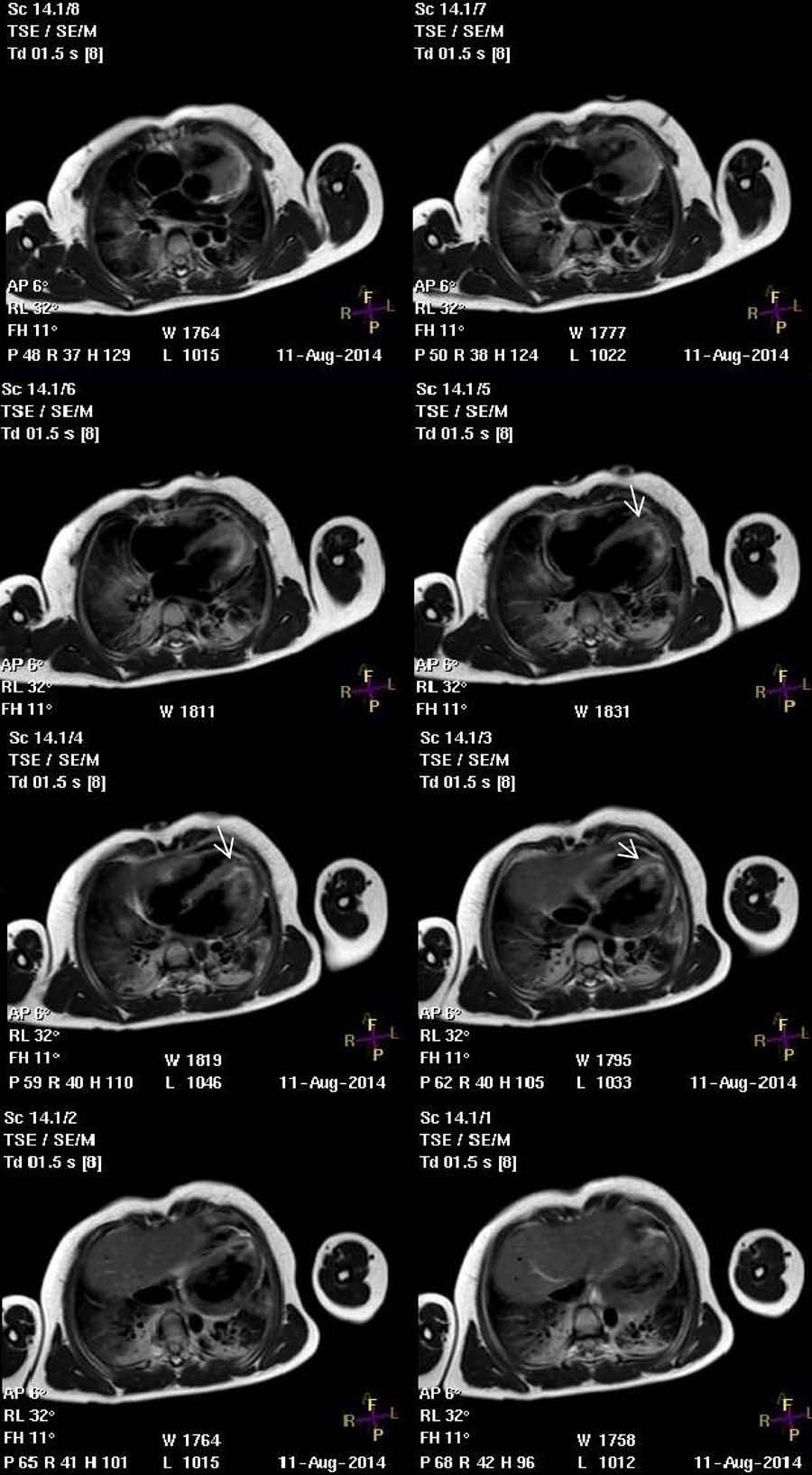 4 Moyé et al Myocardial Contusion in an 8 Year Old Figure 4. Cardiac MRI (CMR) in long-axis planes.