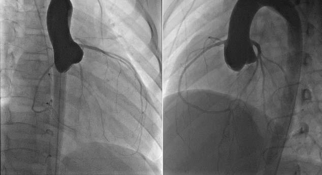 subendocardial region of the septum at the apex in the short-axis (A) and