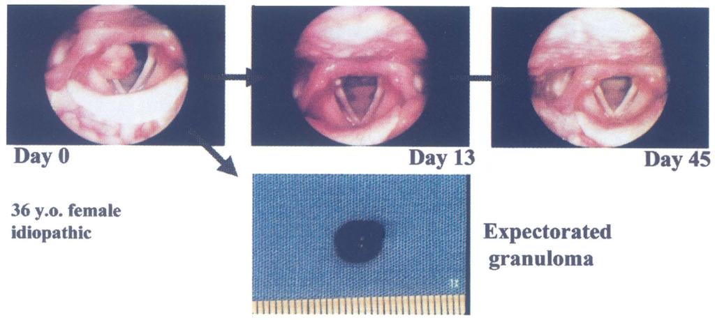 132 S. HORIGUCHI et al. from S.Horiguchi, i.kawabata: Spontaneous expectoration of laryngeal granuloma. Jpn.Bronchoesophagol.Soc., 40 (6), 1989.