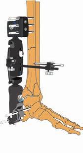 Because the fixator is radiolucent, full Image Intensifier views of the fracture site are available in all planes. The ankle joint should not be left in excessive distraction post-operatively.