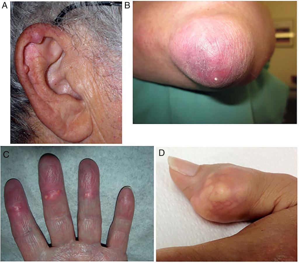 Figure 2 Examples of tophus. The tophus is defined as a draining or chalk-like subcutaneous nodule under transparent skin, often with overlying vascularity.