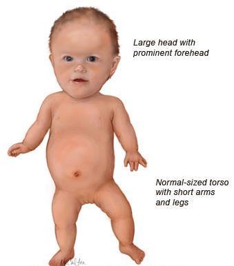 2. ACHONDROPLASIA: autosomal dominant form of dwarfism GENOTYPE AA, Aa Arms and legs do not develop properly Skull is too large Body trunk is normal size Good muscular development
