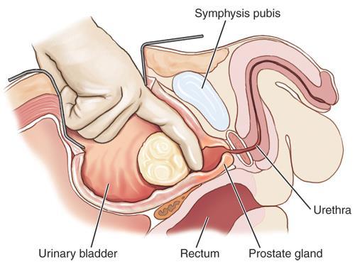 Simple Prostatectomy
