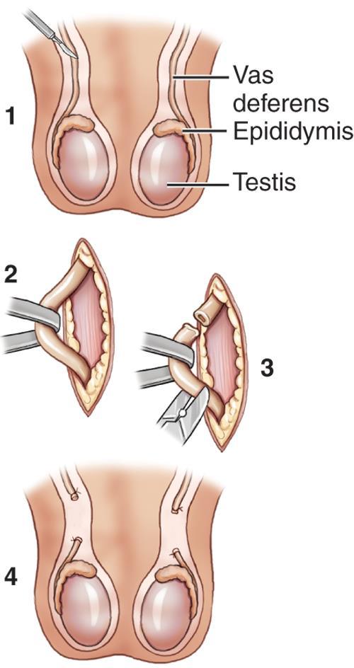 Vasectomy 1. Incision is made into the covering of the vas deferens 2.