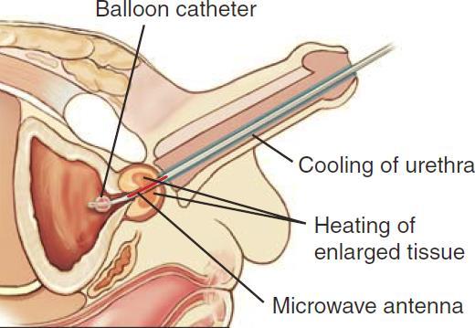 Abbreviations Review Name the abbreviation for the procedure that destroys prostate tissue with heat from microwaves