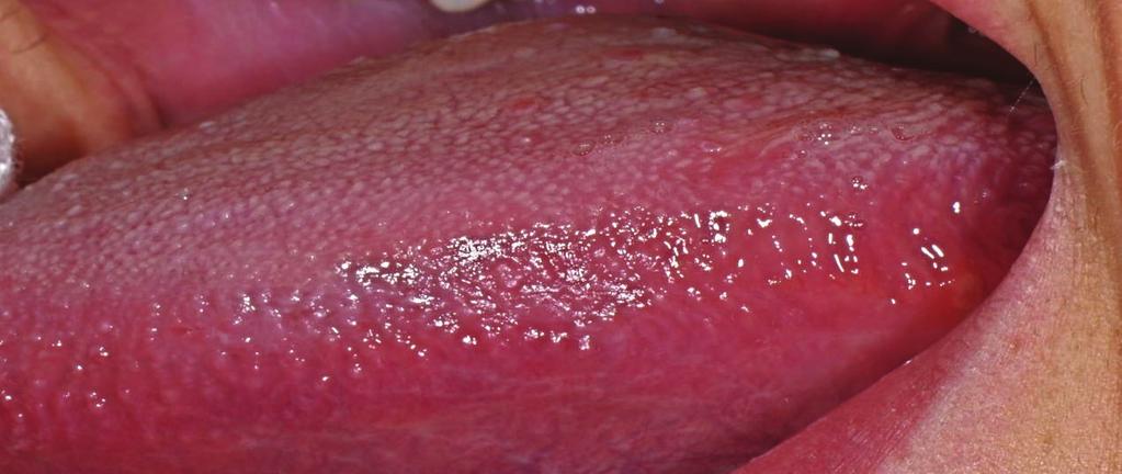 Oral manifestations A Group B Group C Group %(n) %(n) %(n) Recurrent aphotus stomatitis 52% (26) 66.7% (14) 7.4% (4) Geographic tongue 10% (5) 19% (4) 3.7% (2) Burning tongue 14% (7) 9.5% (2) 5.