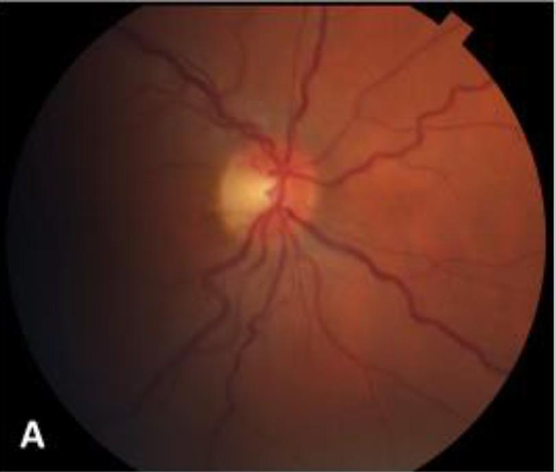 Figure 1. Color Fundus Photos of Patient s Right and Left Eye A. Right eye shows obscuration of the nasal border of the optic disc consistent with grade 1 optic nerve head edema. B.