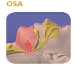 A Review on Sleep Apnea Detection from ECG Signal Soumya Gopal 1, Aswathy Devi T. 2 1 M.