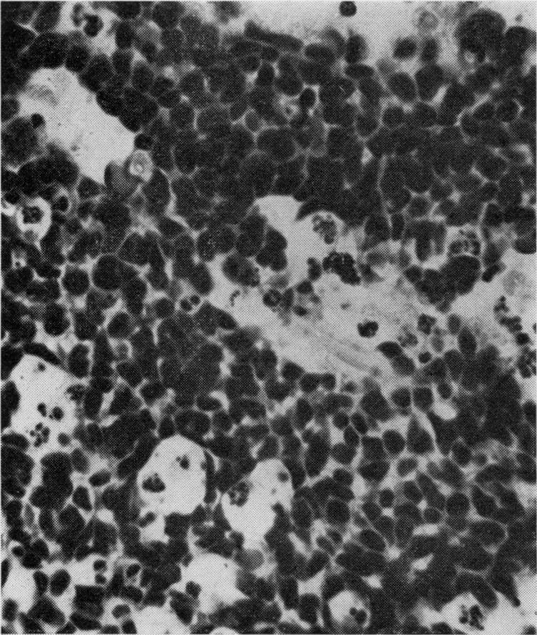 602 Gwyn Morgan F I G. 4 Case I 0, showing high-power view of retinoblastoma in which cells are seen with hyperchromatic nuclei of different shapes and sizes.