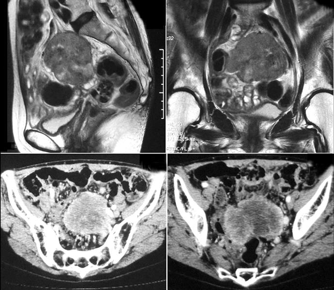 Vol. 60, No. 6, 2017 and treatment of pelvic cavity tumor that was identified at a nearby clinic.