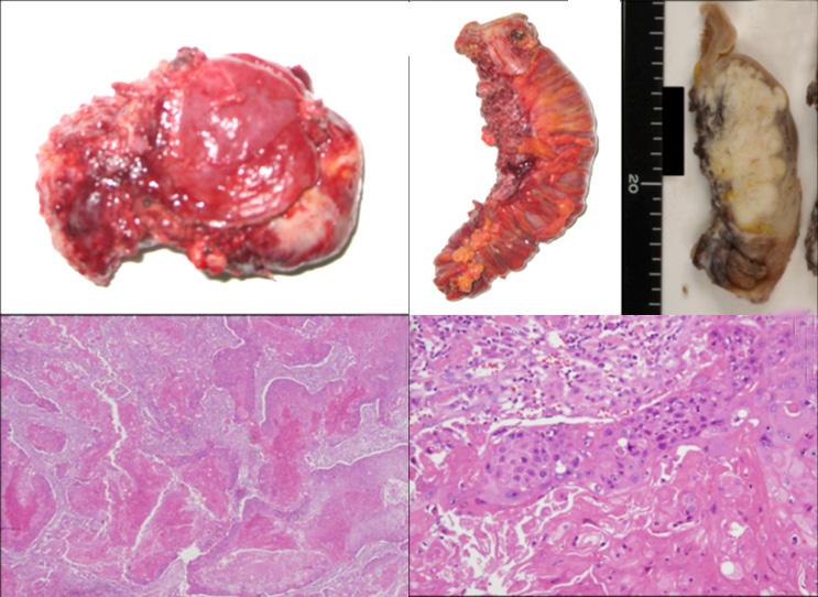 Hiroyuki Yazawa, et al. Long-term survival of advanced ovarian SCC noma, and preservation of these structures was judged to be impossible.
