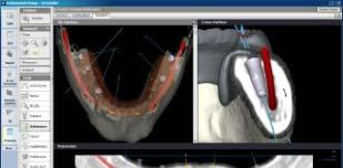 Surgical template service Robust and accurate tracking