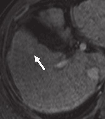 001) between detection of HCCs 1 cm or larger (94% and 91%) and those smaller than TABLE 4: False-Positive Findings in Detection of Hepatocellular Carcinoma on Gadobenate Dimeglumine Enhanced MRI