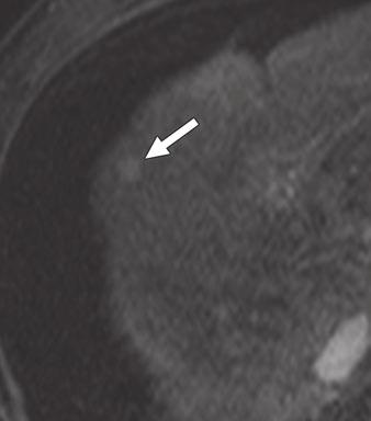 3 38-year-old man with macronodular cirrhosis and 8-mm-diameter dysplastic nodule in liver segment 4.