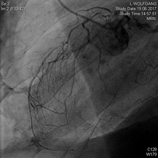 and T-wave inversion in V1 V4, dyspnea NYHA III Coronary Angiography: Successful RCA-PCI, total occlusion of proximal LAD-CTO with