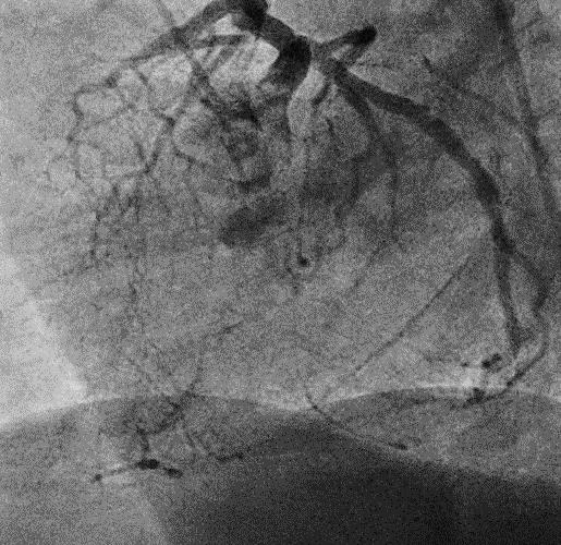 Angina pectoris (CCS II) Coronary Angiography: 04/2017: LAD mid 100%, RCA mid 100% -> PCI LAD (1xBVS) Echocardiography 04/2017: