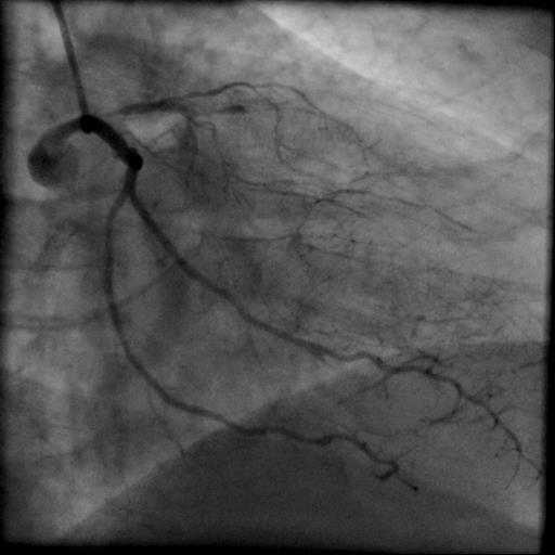 LAD-proximal total occlusion, RIVP-collaterals. RCA with 50% ostial stenosis and good result after proximal stenting.
