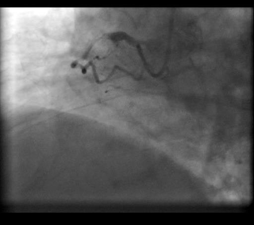 none Coronary Angiography: RCA-proximal total occlusion, LCA-collaterals?