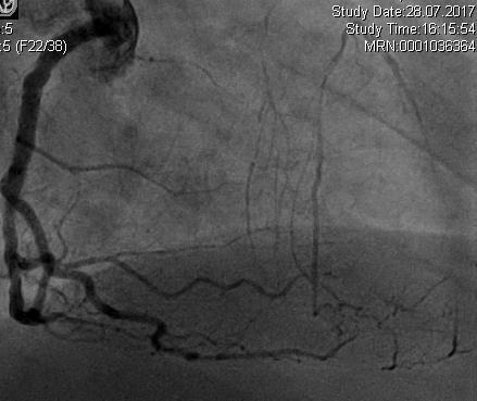Instable angina ECG abnormality: Sinusrhythm, 76/min, LAH, incomplete RSB Coronary Angiography: 06/17